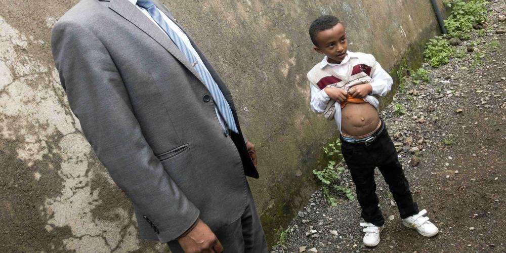 Alazar Angaw Getahun, 7, showing the scars on his stomach after several surgeries in Addis Ababa, Ethiopia. (Andrew McChesney / Adventist Mission)