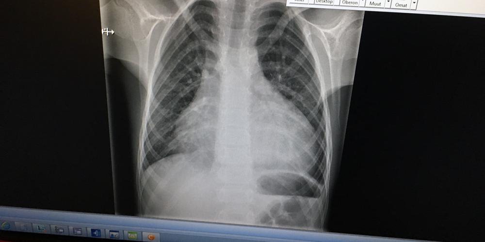 An X-ray image of 8-year-old Alex’s heart, swollen twice its normal size, when he was rushed to a hospital in Finland on a hot summer evening in 2018. (Adventist Mission)